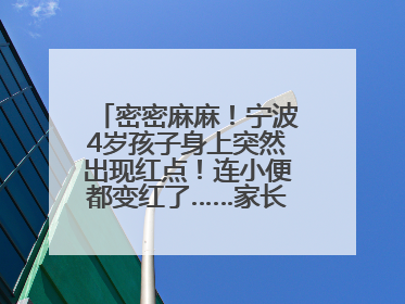 密密麻麻！宁波4岁孩子身上突然出现红点！连小便都变红了……家长：以为只是摔伤
